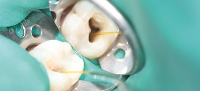 Behandeln ohne lästiges Feilen