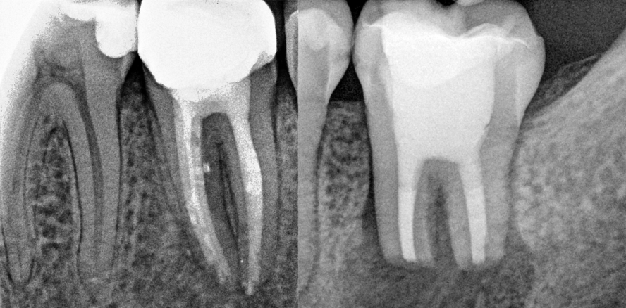 Endodontische Revision – Orthograd, Retrograd, Extrakorporal?