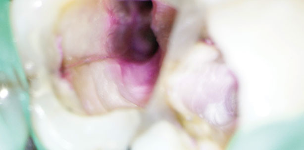 Kanalaufbereitung bei apikaler Parodontitis mit Furkationsbefall