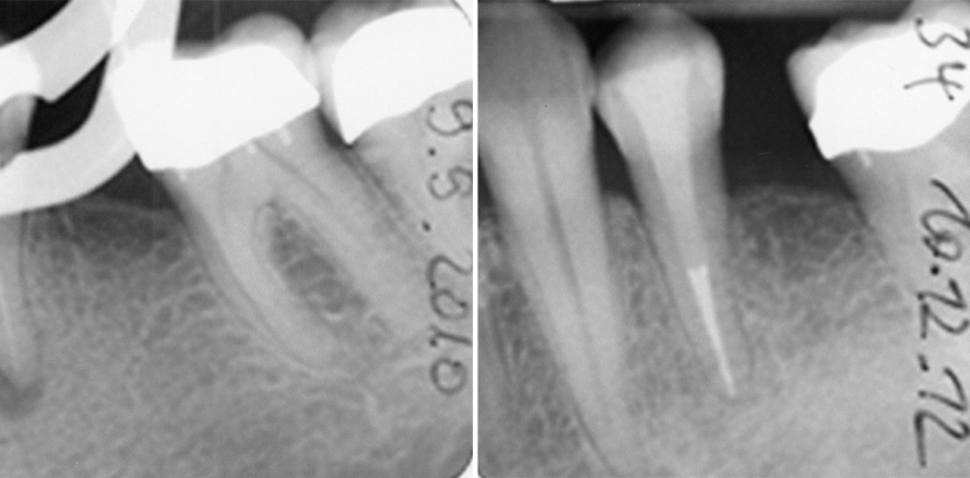 Erfolgreiche Endodontie in nur einer Sitzung!?