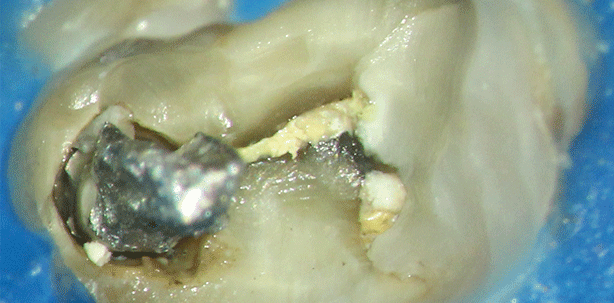 Die Revision eines ersten Molaren im OK mit Instrumentenfragment