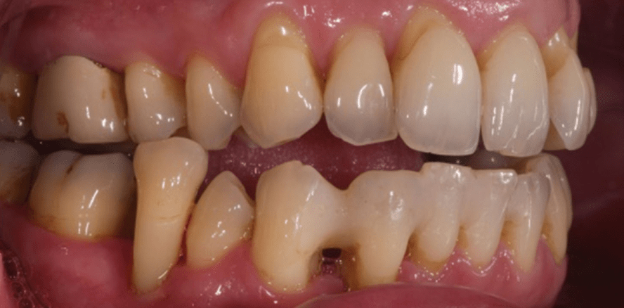 Die Transreplantation als zahnerhaltende Maßnahme