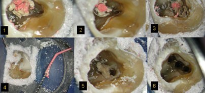 Zahnerhaltende Therapie nach endodontischem Misserfolg