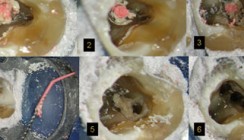 Zahnerhaltende Therapie nach endodontischem Misserfolg