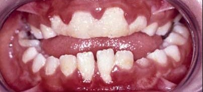 Endokarditisprophylaxe: Was ist seit 2007 anders geworden?