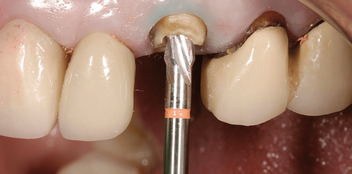 Rekonstruktionsoption für frakturierte endodontisch behandelte Zähne