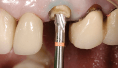Rekonstruktionsoption für frakturierte endodontisch behandelte Zähne