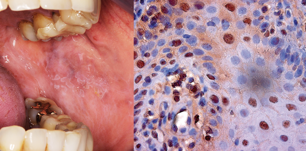 Epitheliale Vorläuferläsionen – Diagnostik und Therapie