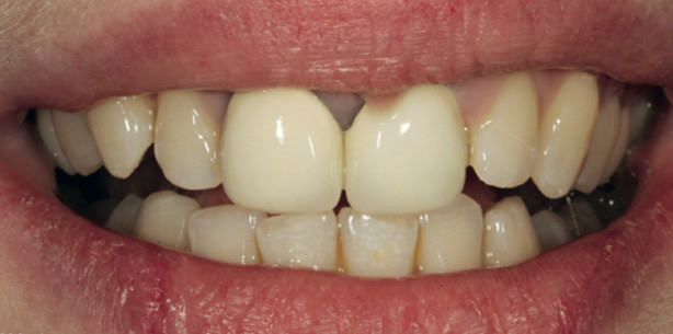 Vollkeramische Frontzahnkronen unter Anwendung von Monobond Etch & Prime