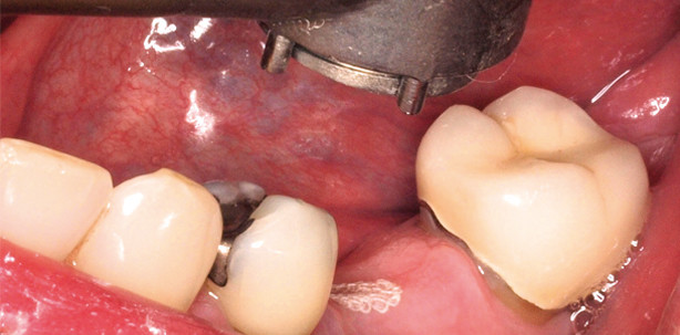 Flächenhafte Gewebsentfernung mit dem Er:YAG-Laser