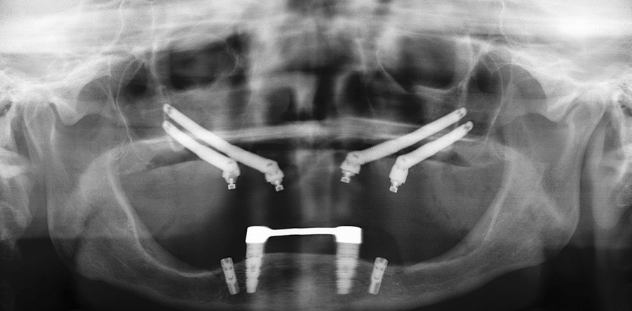 Der komplexe Fall – Sofortversorgung im atrophen Oberkiefer