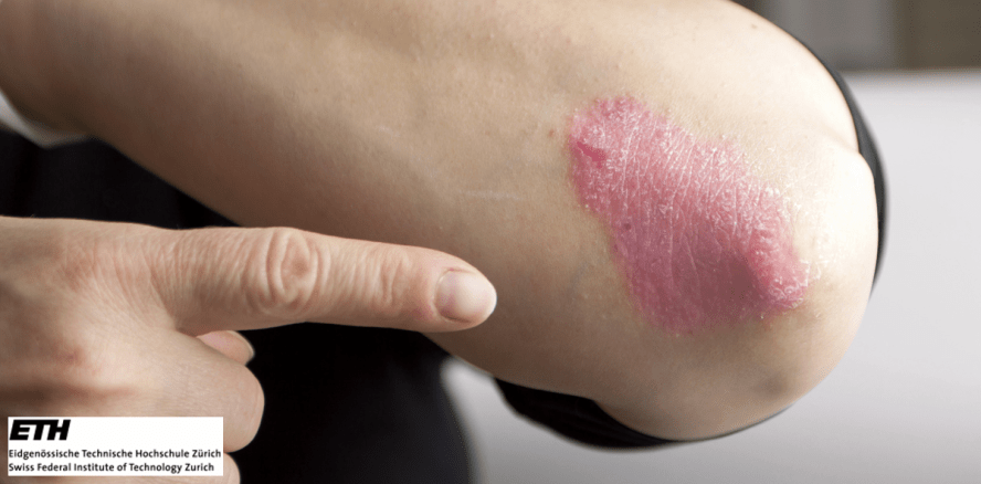 Schuppenflechte: Implantat gibt Gegensteuer