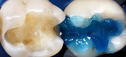 Eine ideale Materialkombination für optimale Ergebnisse