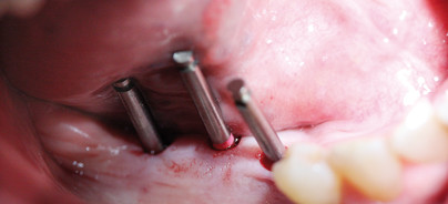 Minimalinvasive Implantation bei multiplen Exostosen