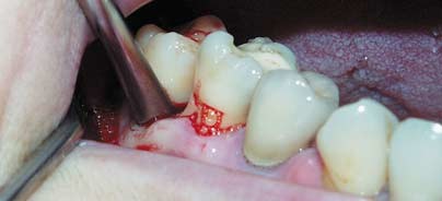 Atraumatische Extraktionen