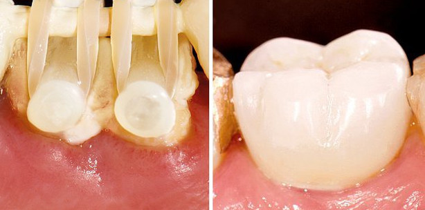 Webinar thematisiert Extrusionstherapie