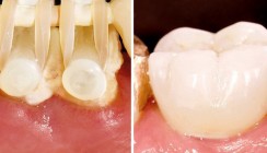 Webinar thematisiert Extrusionstherapie