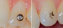 Orales Piercing und Zahnschmuck: Aktuelle Aspekte