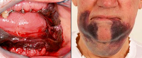Nachblutungen - Chirurgische Problemfälle vermeiden
