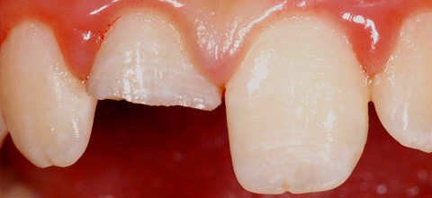 Pulpaamputation oder Apexifikation - Behandlungsmethoden traumatisierter Zähne