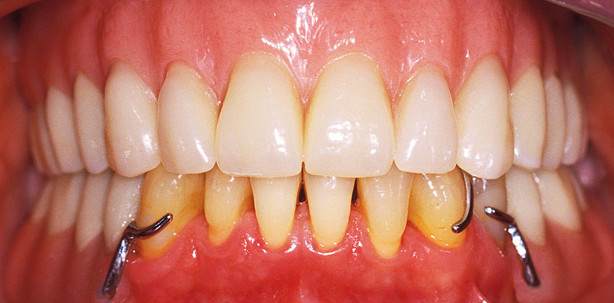 Abnehmbare Geroprothetik