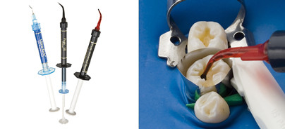 Höchste Haftkräfte für Restaurationen