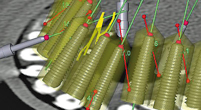 Transdentale 3-D- Implantatplanung