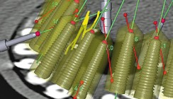 Transdentale 3-D- Implantatplanung