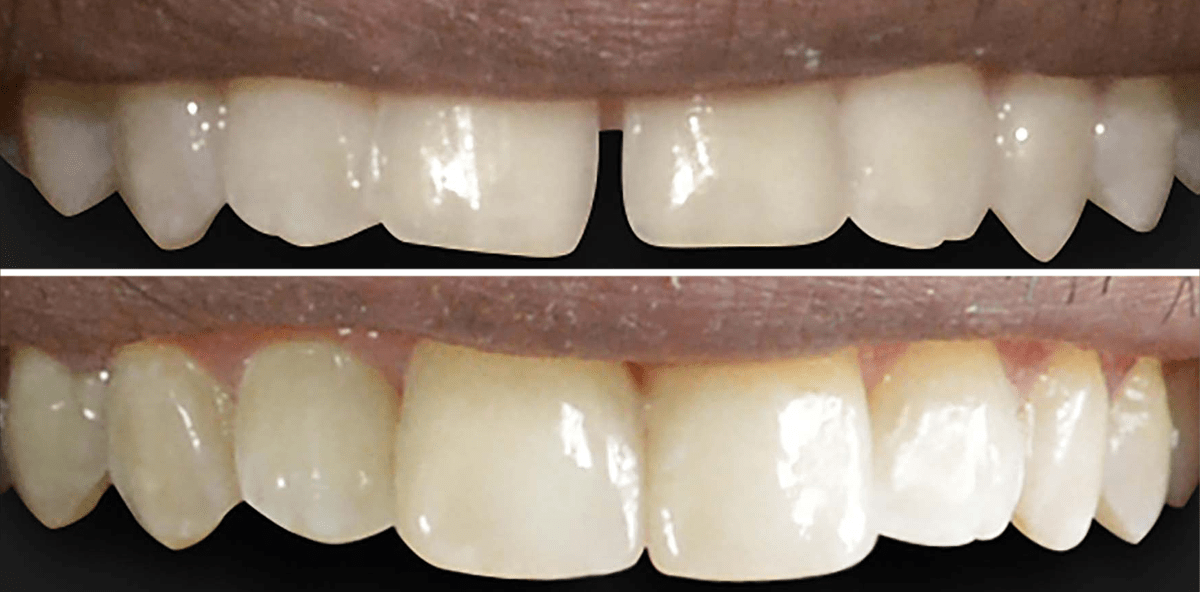 Ästhetische Versorgung eines Diastemas mit Keramikveneers