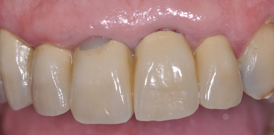 Socket Preservation 3.0: Sofortimplantation mit Keramikimplantaten