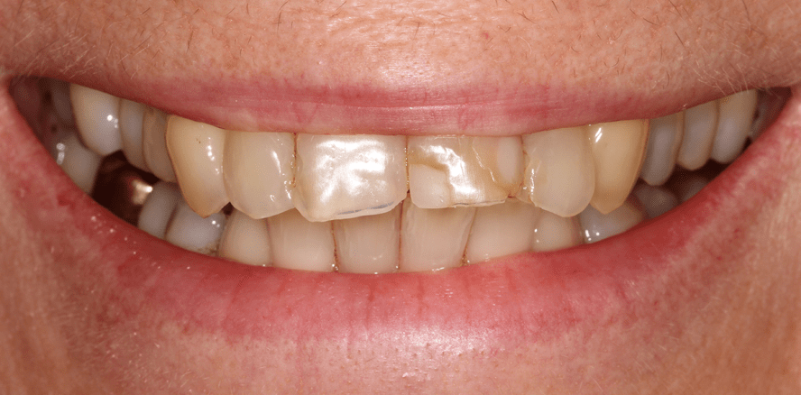 Socket Preservation 3.0: Sofortimplantation mit Keramikimplantaten