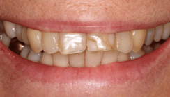 Socket Preservation 3.0: Sofortimplantation mit Keramikimplantaten