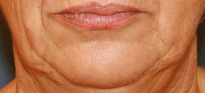 Das Minilifting – Indikationen und Möglichkeiten