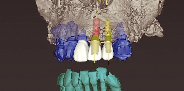 3-D-gesteuerte Implantation mit ­Sofortbelastung im ästhetischen Bereich