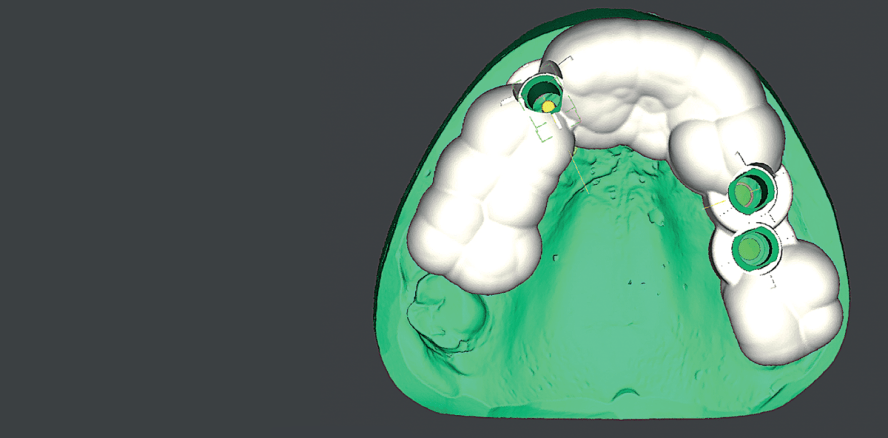 Keramikimplantat in ästhetischer Zone mit provisorischer Versorgung