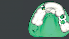 Keramikimplantat in ästhetischer Zone mit provisorischer Versorgung