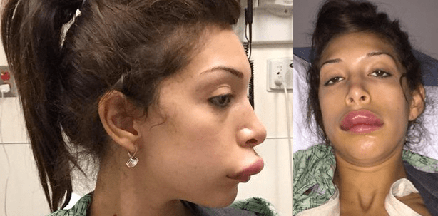 „Teen-Mom“ riskiert dicke Lippe