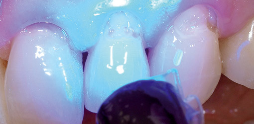 Die Frontzahnrestauration ohne Säure