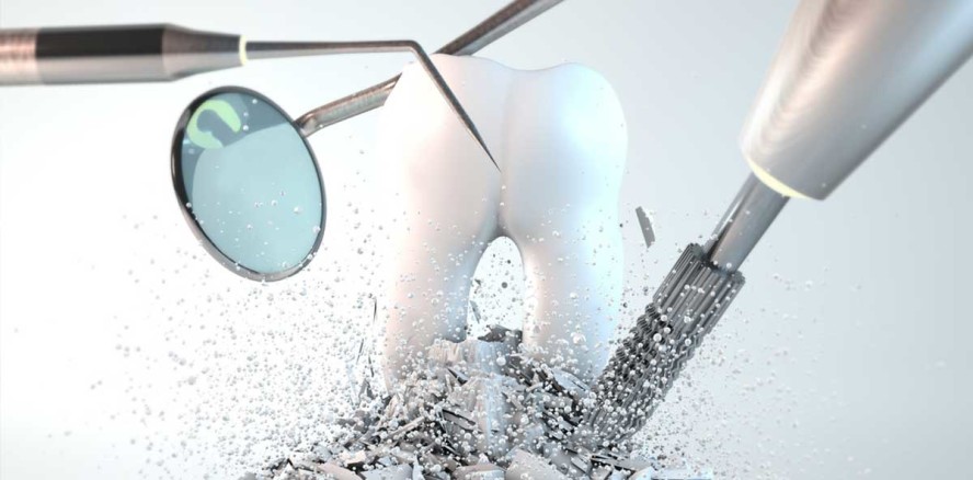 FDI legt Whitepaper zur Behandlung von Karies vor