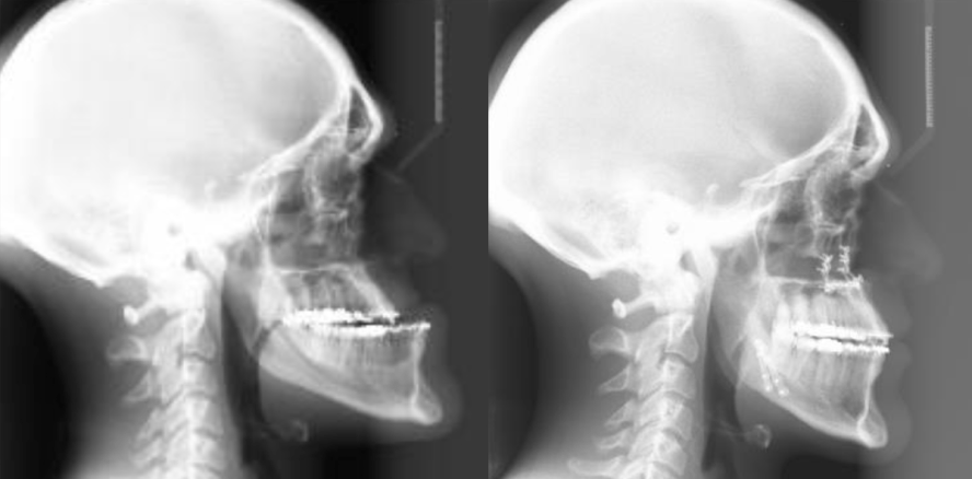 Hirntumor verursacht extremen Fehlbiss