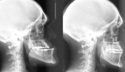 Hirntumor verursacht extremen Fehlbiss