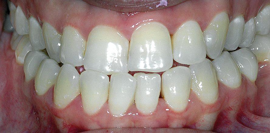 Kombinierte kieferorthopädisch-kieferchirurgische Therapie