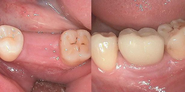 Feste Zähne an einem Tag „Einfach, schonend, schnell“
