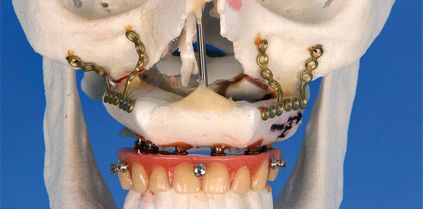 Kieferrekonstruktion: Fibulatransplantate mit osseointegrierten Dentalimplantaten