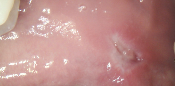 Laserbehandlung eines Fibroms