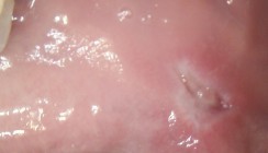 Laserbehandlung eines Fibroms