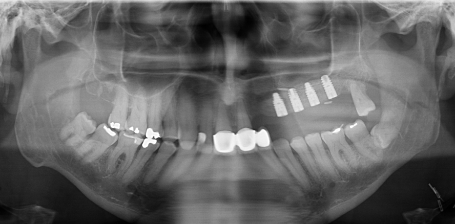 DVT-Diagnostik bei ­Gefäßstielverknöcherung nach ­Fibula-Transplantation