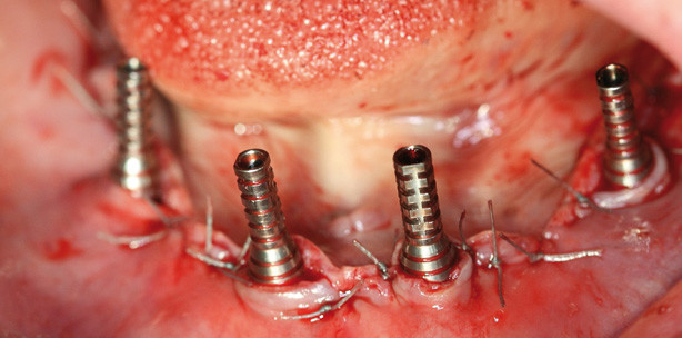 Fast- & Fixed-Therapiekonzept – auch bei Parodontitis profunda