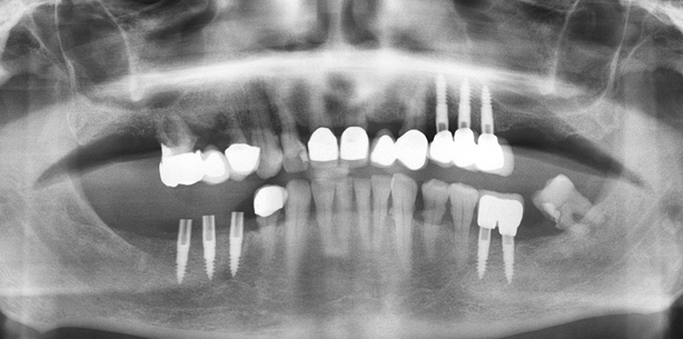 Versorgung des Freiendsattels flapless auf einteiligen Implantaten