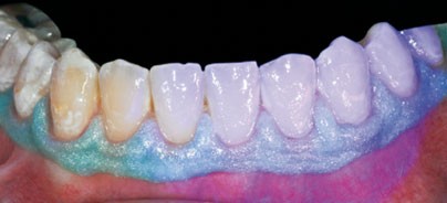 Mikro-invasive Behandlung von post-orthodontischen White Spots auf Glattflächen